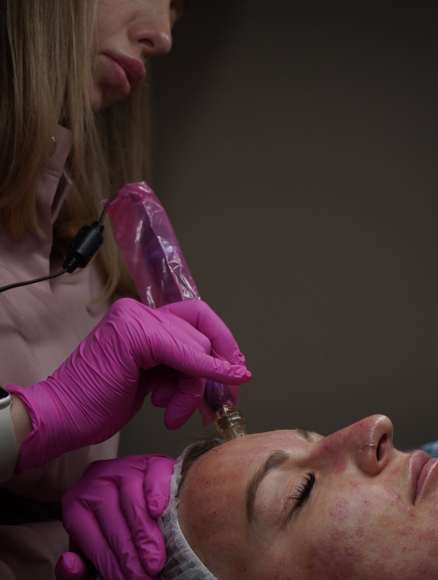 Person receiving microneedling 