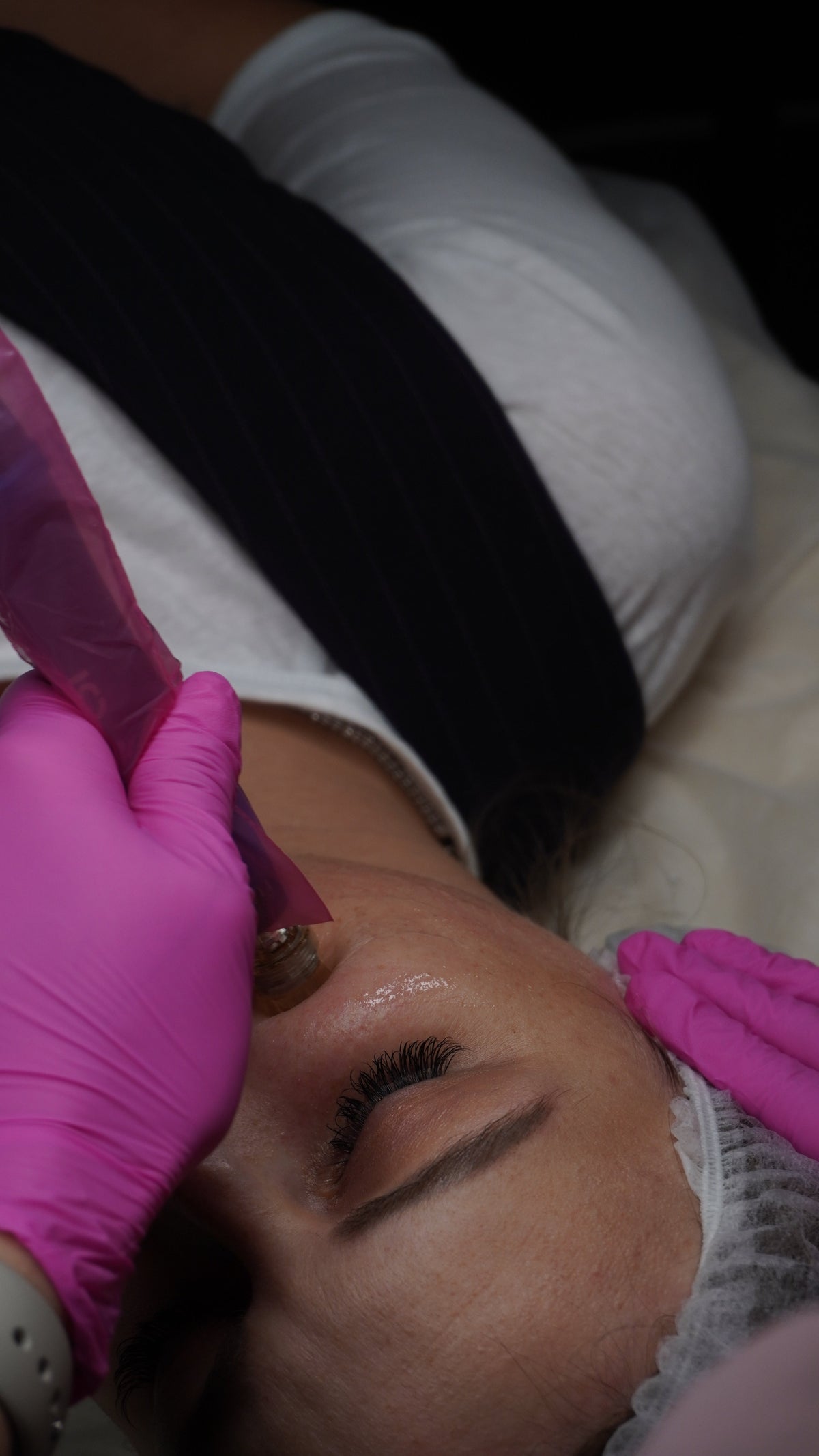 Person receiving a microneedling procedure with gloves on hands