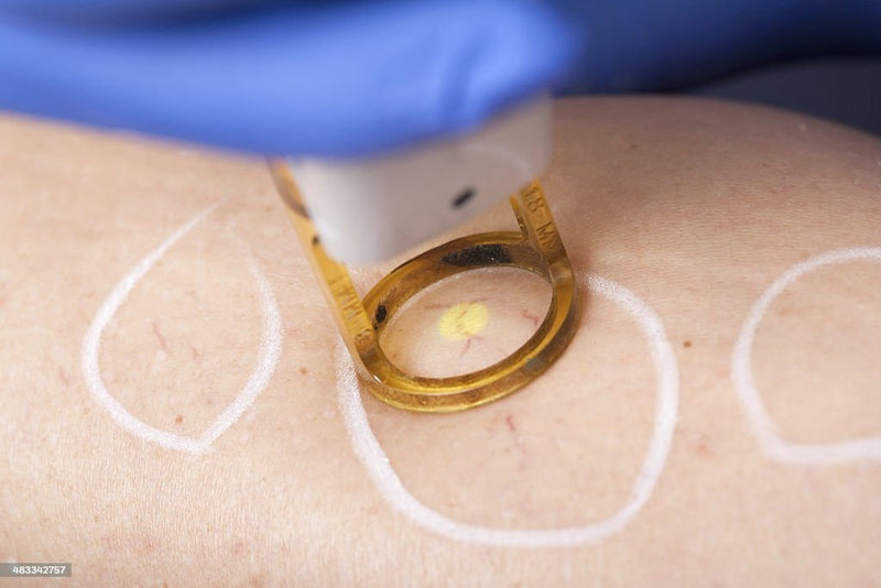 Close-up of a vascular removal procedure on a person's leg with a gloved hand holding the laser device.