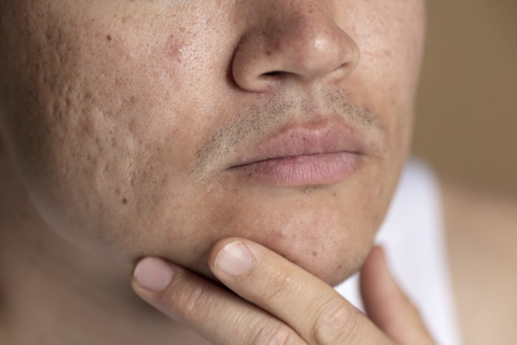 Men with Acne scars, Microneedling Treatment at Everskin Laser Salon