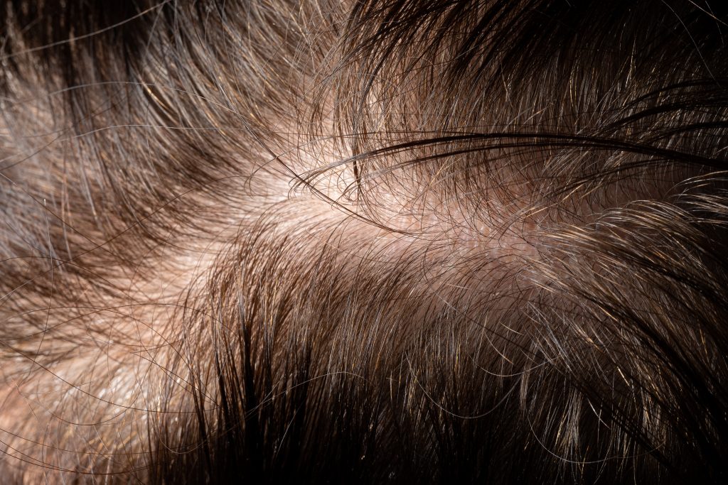 scalp with baldness and hair loss problems. Seborrheic dermatitis that loses hair