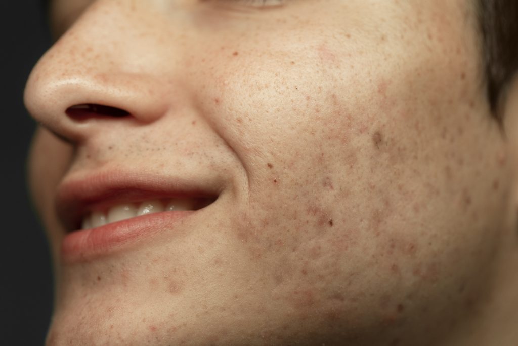 Acne scars, acne, facials, Richmond Hill