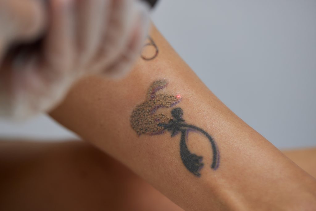 Women's leg with tattoo Removal at Everskin Laser Salon Richmond Hill