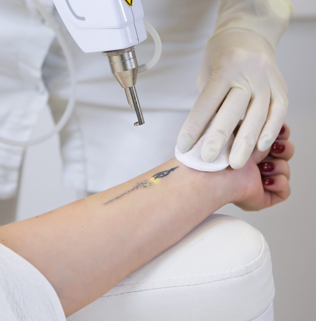 Women is getting laser tattoo removal